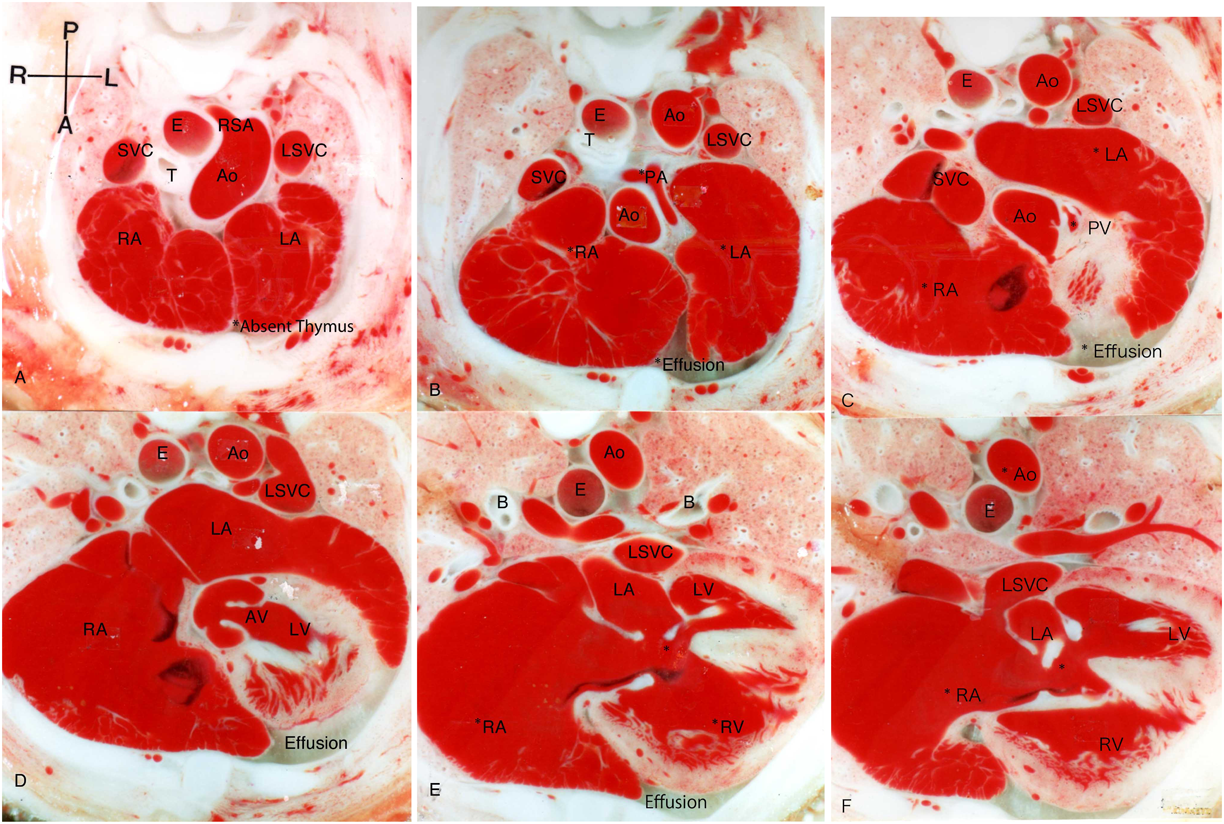Pediatric Cardiology and Cardiac Surgery 34(2): 55-62 (2018)
