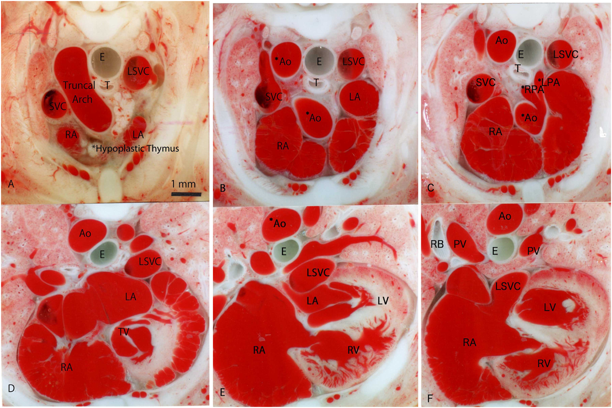 Pediatric Cardiology and Cardiac Surgery 34(2): 55-62 (2018)