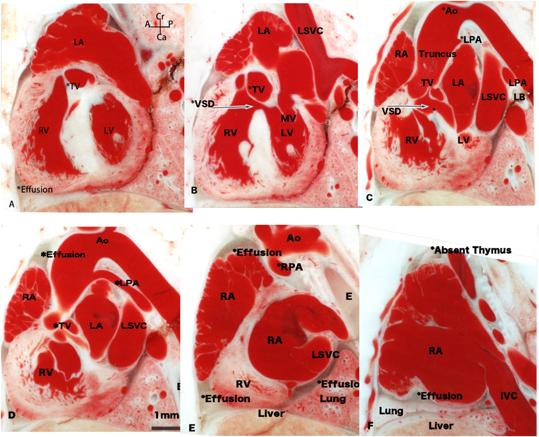 Pediatric Cardiology and Cardiac Surgery 34(2): 55-62 (2018)