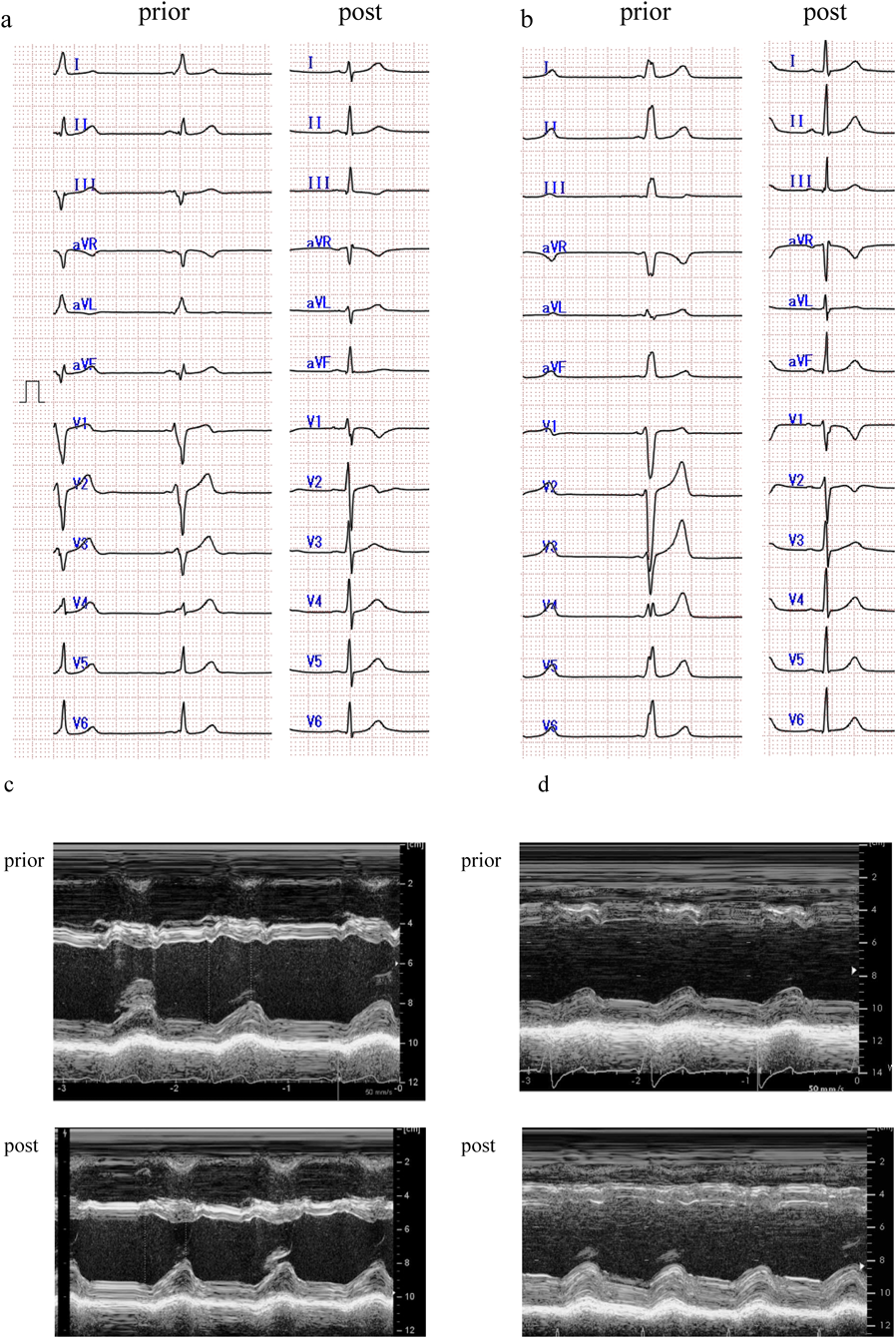 Pediatric Cardiology and Cardiac Surgery 34(2): 63-71 (2018)