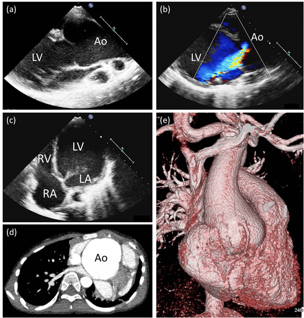 Pediatric Cardiology and Cardiac Surgery 34(2): 77-83 (2018)