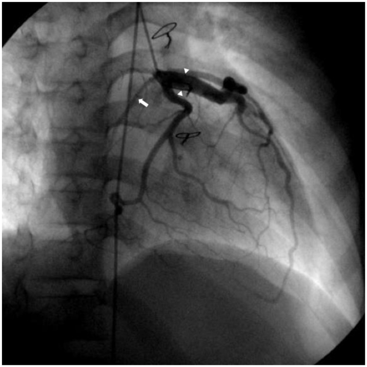 Pediatric Cardiology and Cardiac Surgery 35(2): 127-131 (2019)