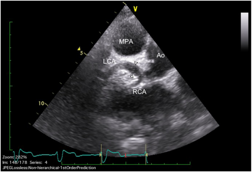Pediatric Cardiology and Cardiac Surgery 35(2): 127-131 (2019)