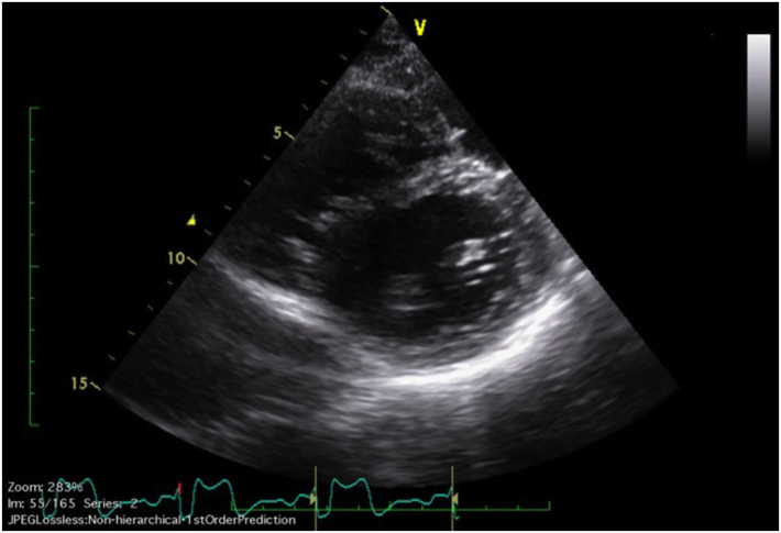 Pediatric Cardiology and Cardiac Surgery 35(2): 127-131 (2019)
