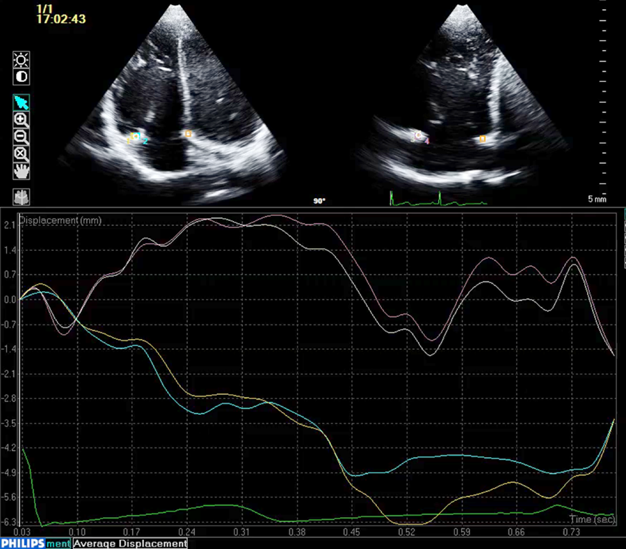 Pediatric Cardiology and Cardiac Surgery 35(1): 30-37 (2019)