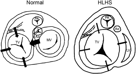 Pediatric Cardiology and Cardiac Surgery 35(1): 30-37 (2019)