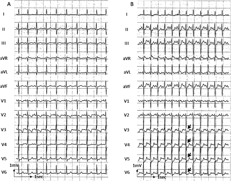 Pediatric Cardiology and Cardiac Surgery 35(1): 38-42 (2019)