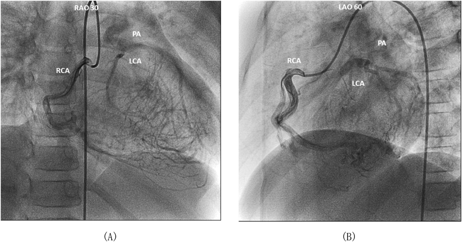 Pediatric Cardiology and Cardiac Surgery 35(1): 38-42 (2019)