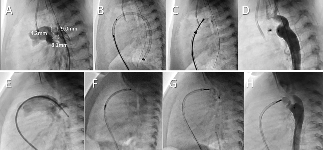 Pediatric Cardiology and Cardiac Surgery 36(2): 133-142 (2020)