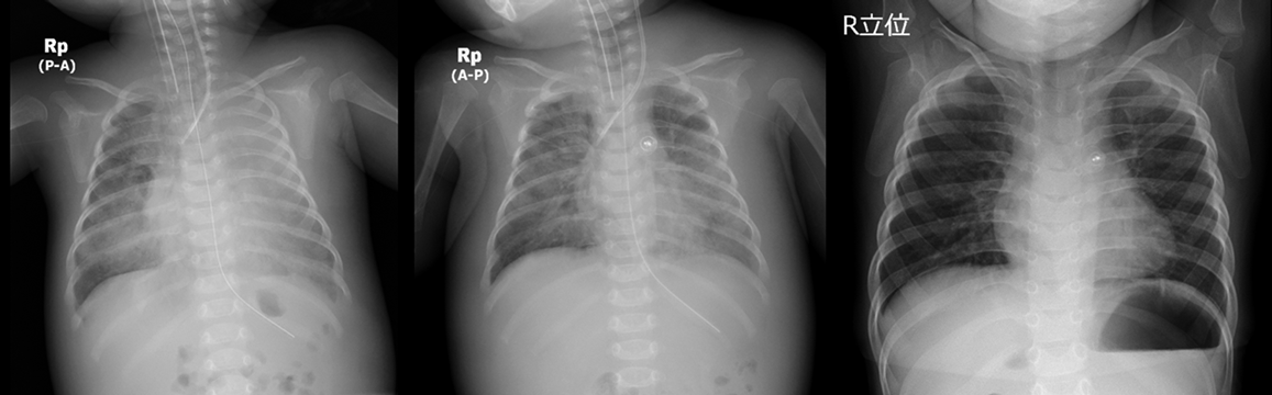 Pediatric Cardiology and Cardiac Surgery 36(2): 133-142 (2020)