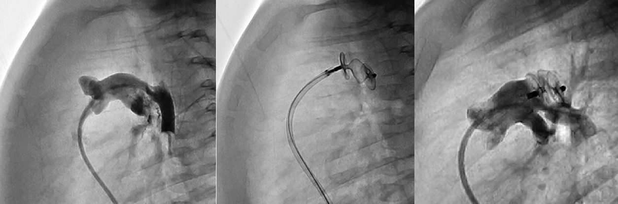 Pediatric Cardiology and Cardiac Surgery 36(2): 133-142 (2020)