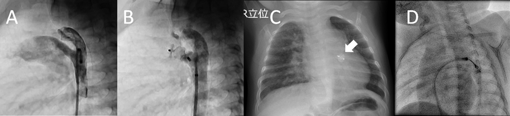 Pediatric Cardiology and Cardiac Surgery 36(2): 133-142 (2020)