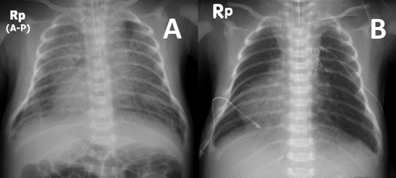 Pediatric Cardiology and Cardiac Surgery 36(2): 143-149 (2020)