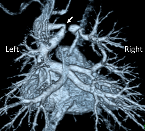 Pediatric Cardiology and Cardiac Surgery 36(2): 143-149 (2020)