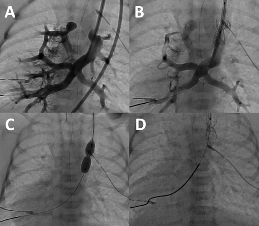Pediatric Cardiology and Cardiac Surgery 36(2): 143-149 (2020)