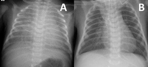 Pediatric Cardiology and Cardiac Surgery 36(2): 143-149 (2020)