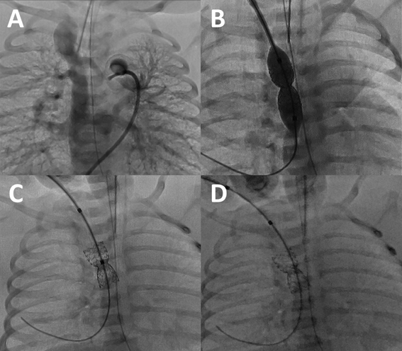 Pediatric Cardiology and Cardiac Surgery 36(2): 143-149 (2020)