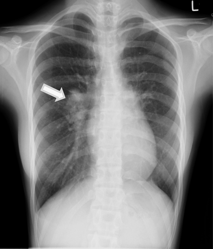 Pediatric Cardiology and Cardiac Surgery 36(2): 152-156 (2020)