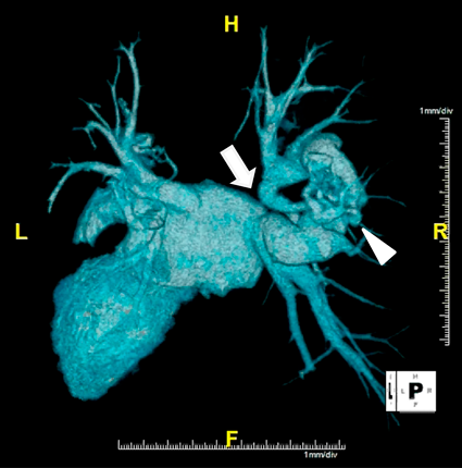 Pediatric Cardiology and Cardiac Surgery 36(2): 152-156 (2020)
