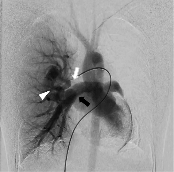Pediatric Cardiology and Cardiac Surgery 36(2): 152-156 (2020)
