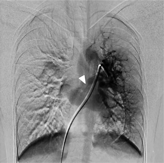 Pediatric Cardiology and Cardiac Surgery 36(2): 152-156 (2020)