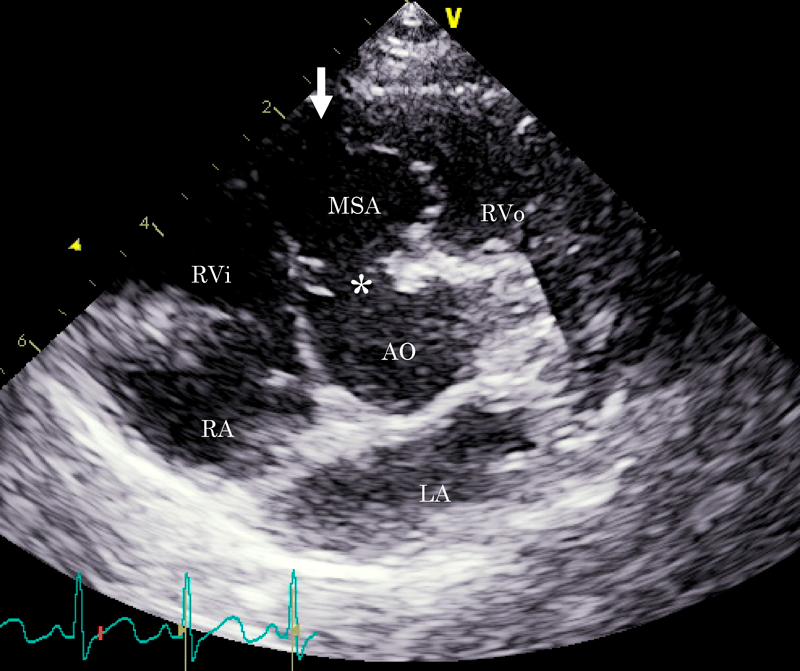Pediatric Cardiology and Cardiac Surgery 36(3): 252-255 (2020)