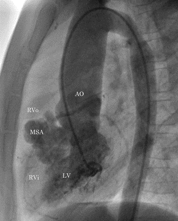 Pediatric Cardiology and Cardiac Surgery 36(3): 252-255 (2020)
