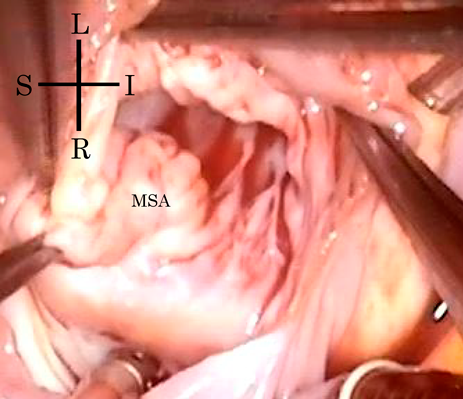 Pediatric Cardiology and Cardiac Surgery 36(3): 252-255 (2020)