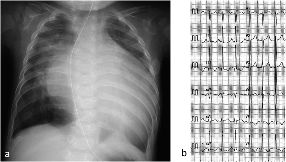 Pediatric Cardiology and Cardiac Surgery 36(3): 256-262 (2020)