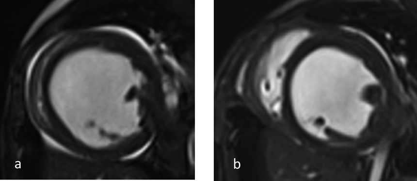 Pediatric Cardiology and Cardiac Surgery 36(3): 256-262 (2020)