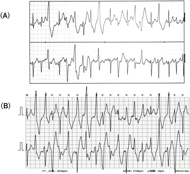 Pediatric Cardiology and Cardiac Surgery 37(2): 144-150 (2021)