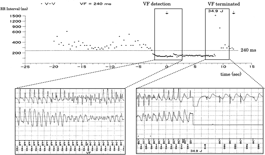Pediatric Cardiology and Cardiac Surgery 37(2): 144-150 (2021)