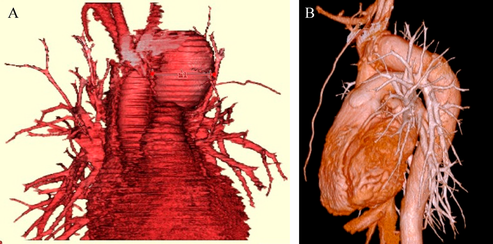 Pediatric Cardiology and Cardiac Surgery 38(2): 140-144 (2022)