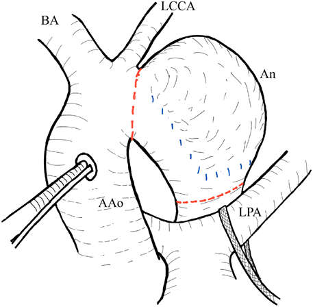 Pediatric Cardiology and Cardiac Surgery 38(2): 140-144 (2022)