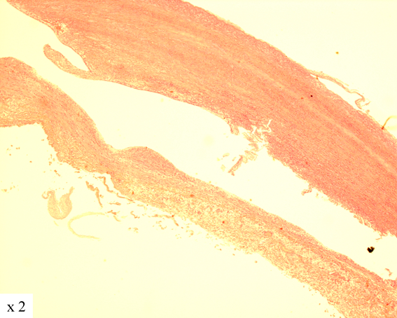 Pediatric Cardiology and Cardiac Surgery 38(2): 140-144 (2022)