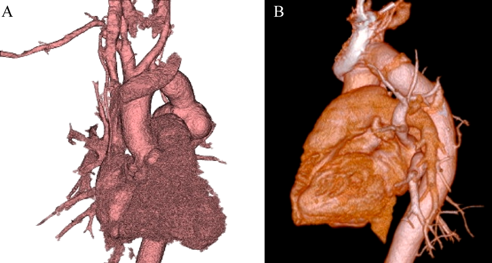 Pediatric Cardiology and Cardiac Surgery 38(2): 140-144 (2022)