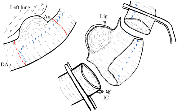 Pediatric Cardiology and Cardiac Surgery 38(2): 140-144 (2022)