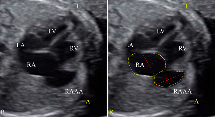 Pediatric Cardiology and Cardiac Surgery 38(3): 198-203 (2022)