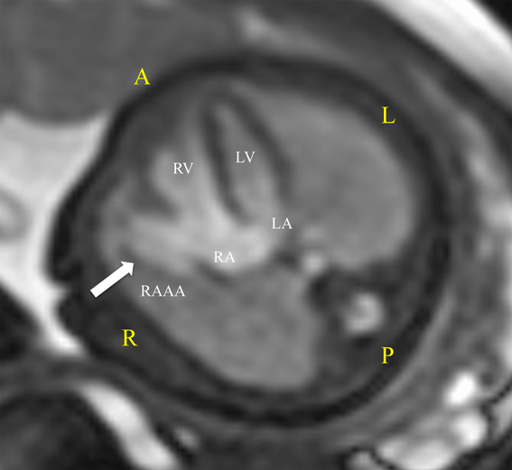 Pediatric Cardiology and Cardiac Surgery 38(3): 198-203 (2022)