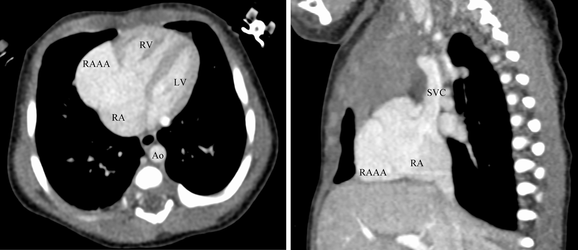Pediatric Cardiology and Cardiac Surgery 38(3): 198-203 (2022)