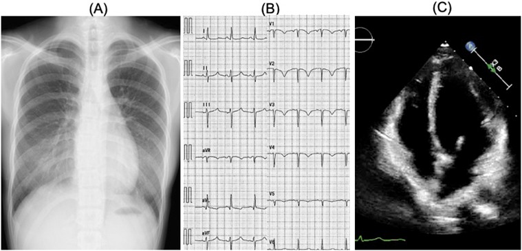 Pediatric Cardiology and Cardiac Surgery 38(4): 249-253 (2022)