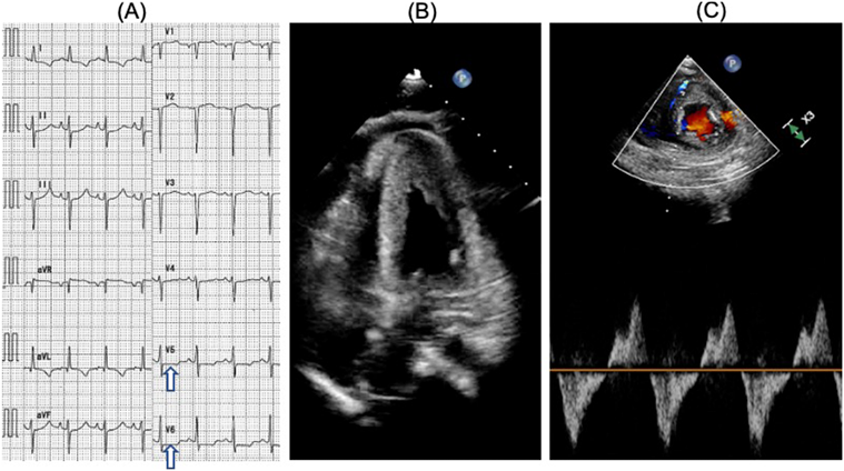 Pediatric Cardiology and Cardiac Surgery 38(4): 249-253 (2022)
