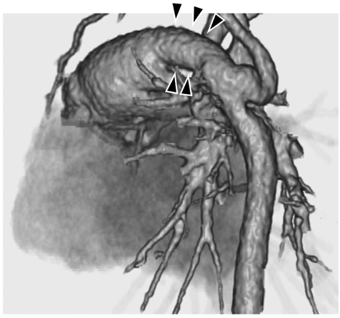 Pediatric Cardiology and Cardiac Surgery 39(1): 25-30 (2023)