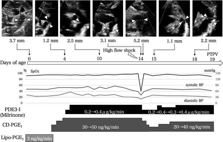 Pediatric Cardiology and Cardiac Surgery 39(1): 25-30 (2023)