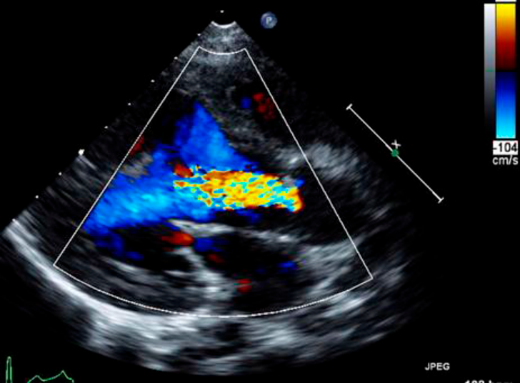 Pediatric Cardiology and Cardiac Surgery 39(1): 31-36 (2023)