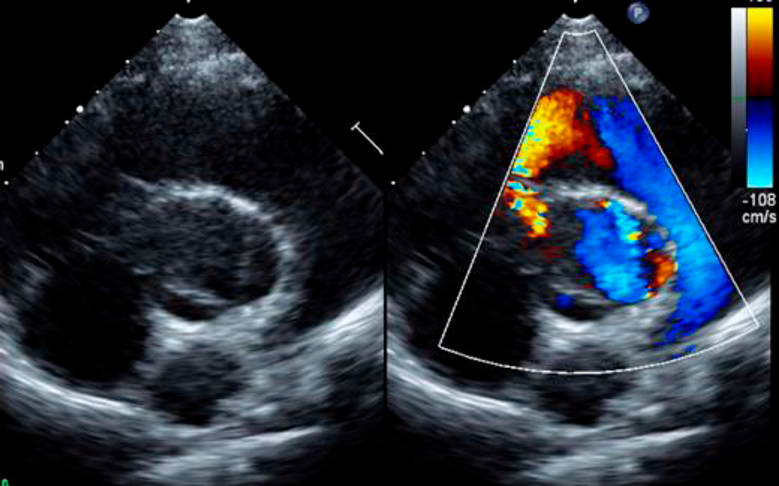 Pediatric Cardiology and Cardiac Surgery 39(1): 31-36 (2023)