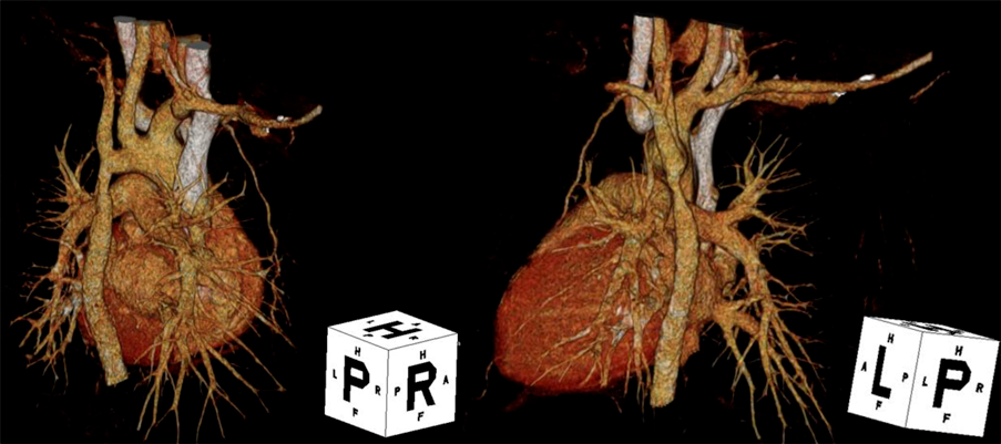 Pediatric Cardiology and Cardiac Surgery 39(1): 31-36 (2023)