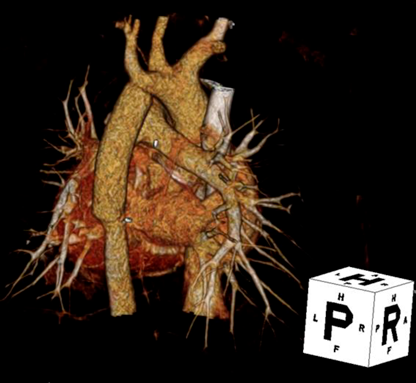 Pediatric Cardiology and Cardiac Surgery 39(1): 31-36 (2023)