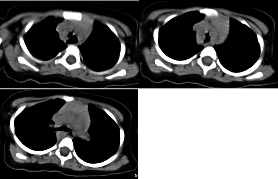 Pediatric Cardiology and Cardiac Surgery 40(2): 132-137 (2024)