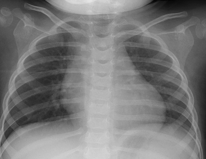 Pediatric Cardiology and Cardiac Surgery 40(2): 132-137 (2024)